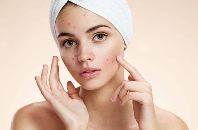 Want an acne-free skin post makeup? Have a look at these expert-recommended tips 